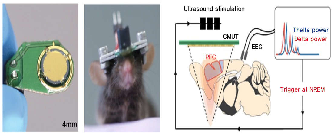 Dispositivo de ultrassom ultrassônico baseado em MEMS desenvolvido pela equipe de pesquisa (apresentado pelo professor Hyunjoo Lee)